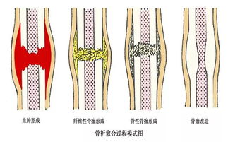 骨密度对骨折愈合的影响有多大